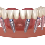 Impianti dentali Albania Prezzi