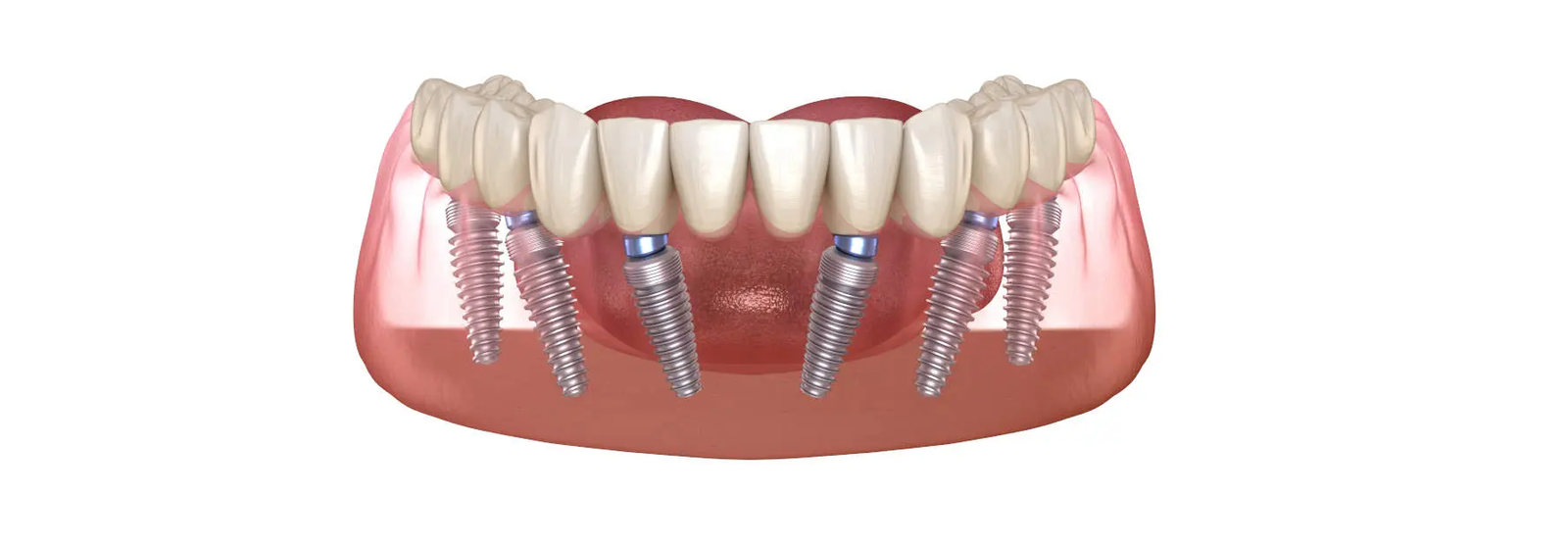 Impianti dentali Albania Prezzi