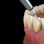 Parodontite cronica e diffusa alternativa impianti dentali