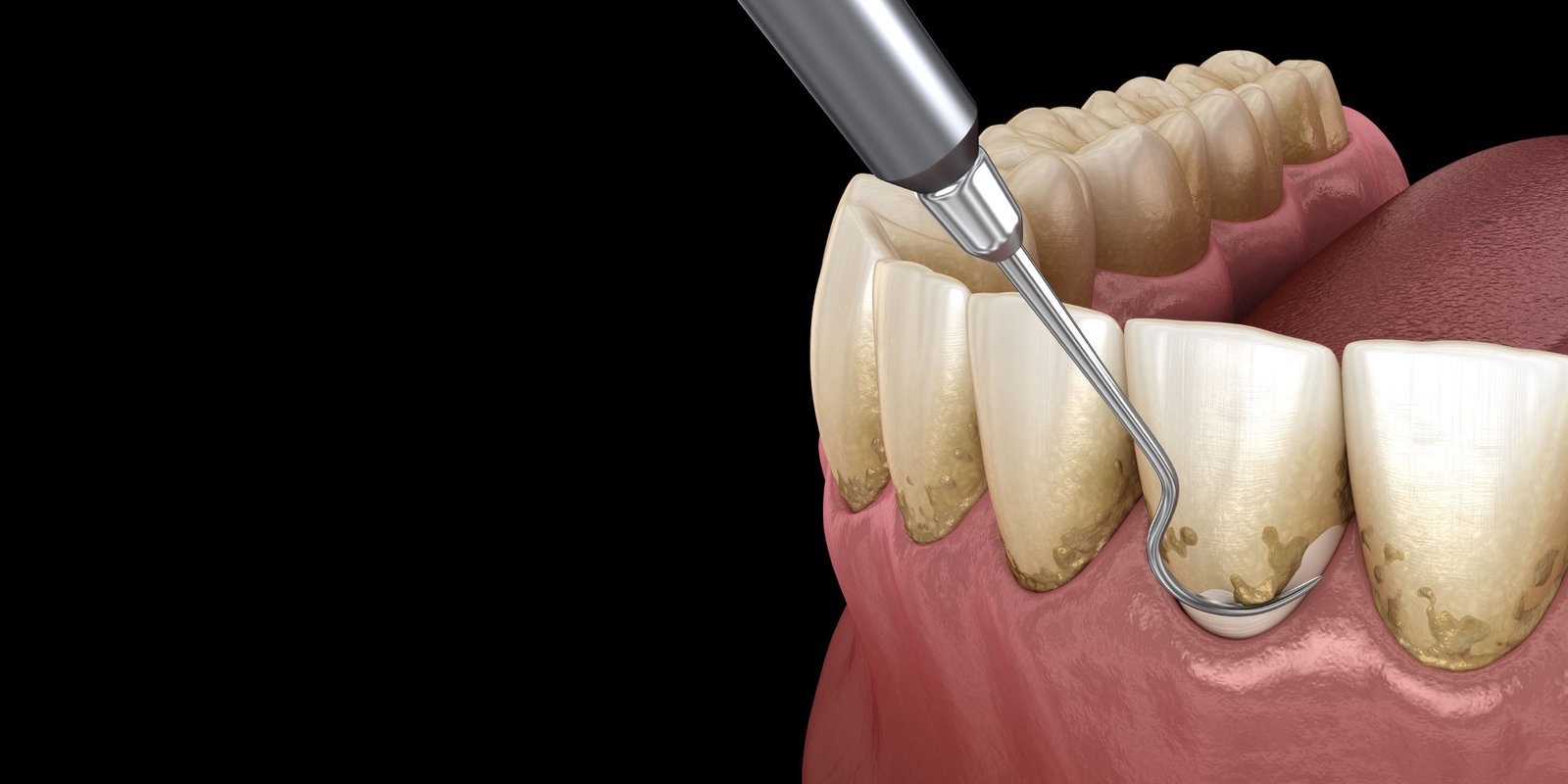 Parodontite cronica e diffusa alternativa impianti dentali