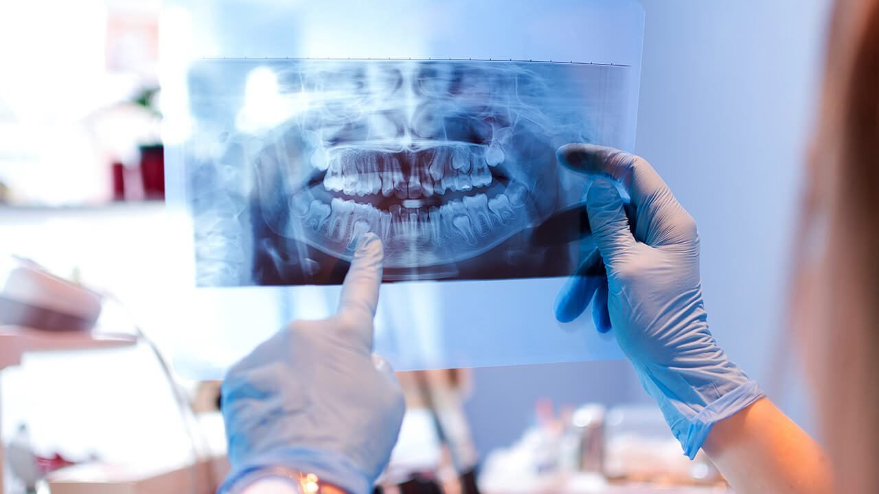 Capire il costo degli impianti dentali in Albania